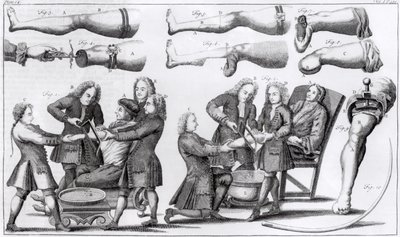 Opérations chirurgicales sur les membres - English School